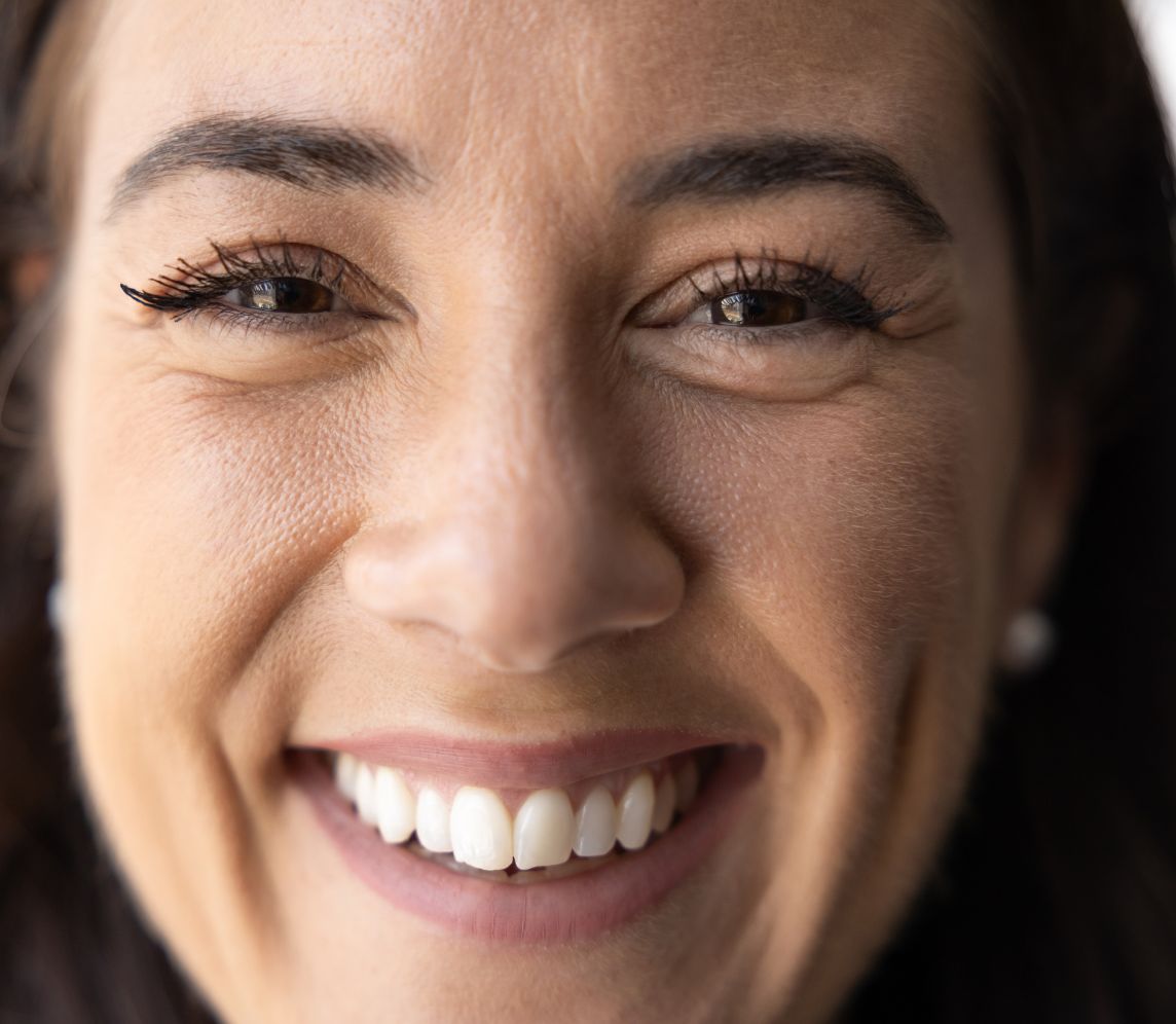Dental veneers