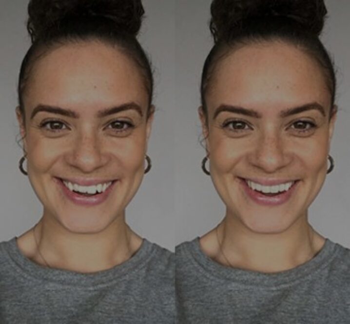 Invisalign®
