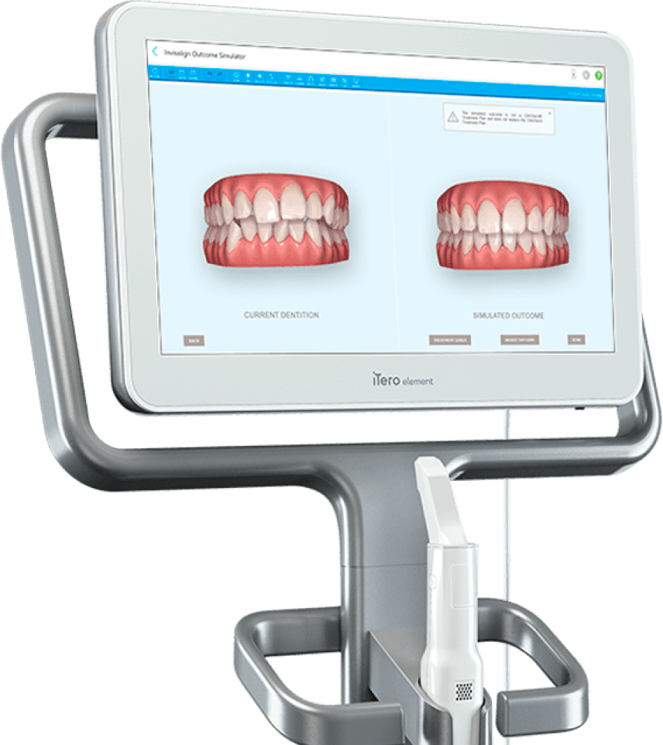 Invisalign scan