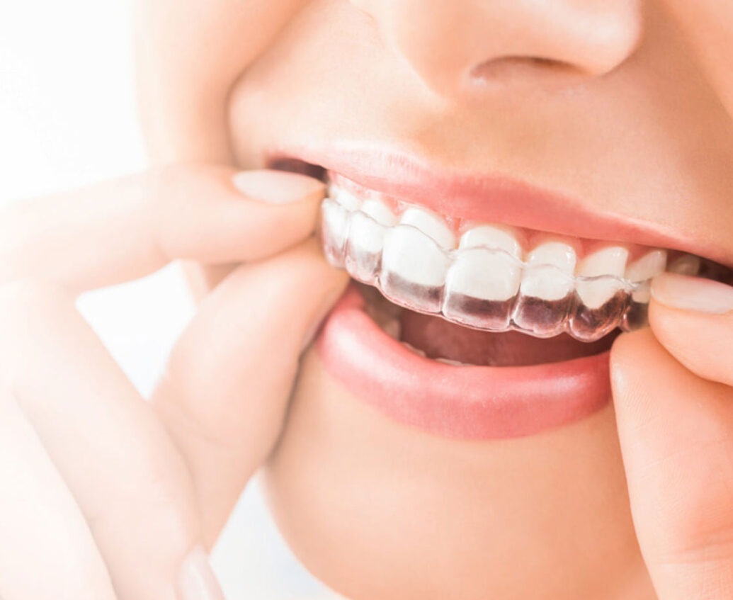 Invisalign